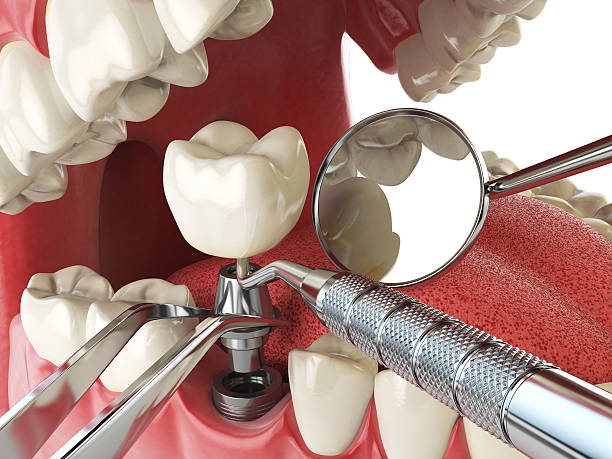 Best Lost Filling or Crown Replacement in Sweetwater, TX